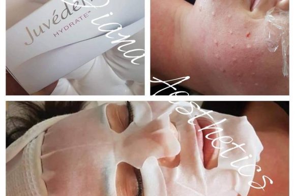 OFFER – 15% OFF BIOREVITALIZATION LIMITED TIME