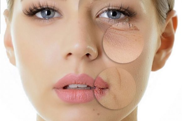 MESOTHERAPY
